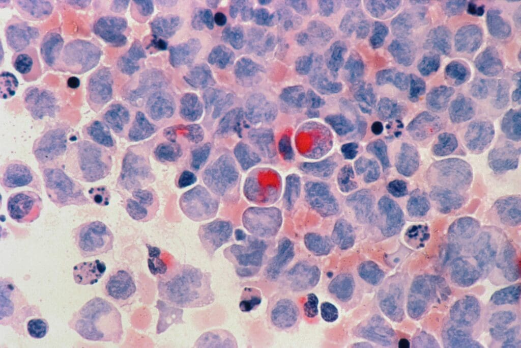 Acute myelocytic leukaemia <noread>(AML)</noread>